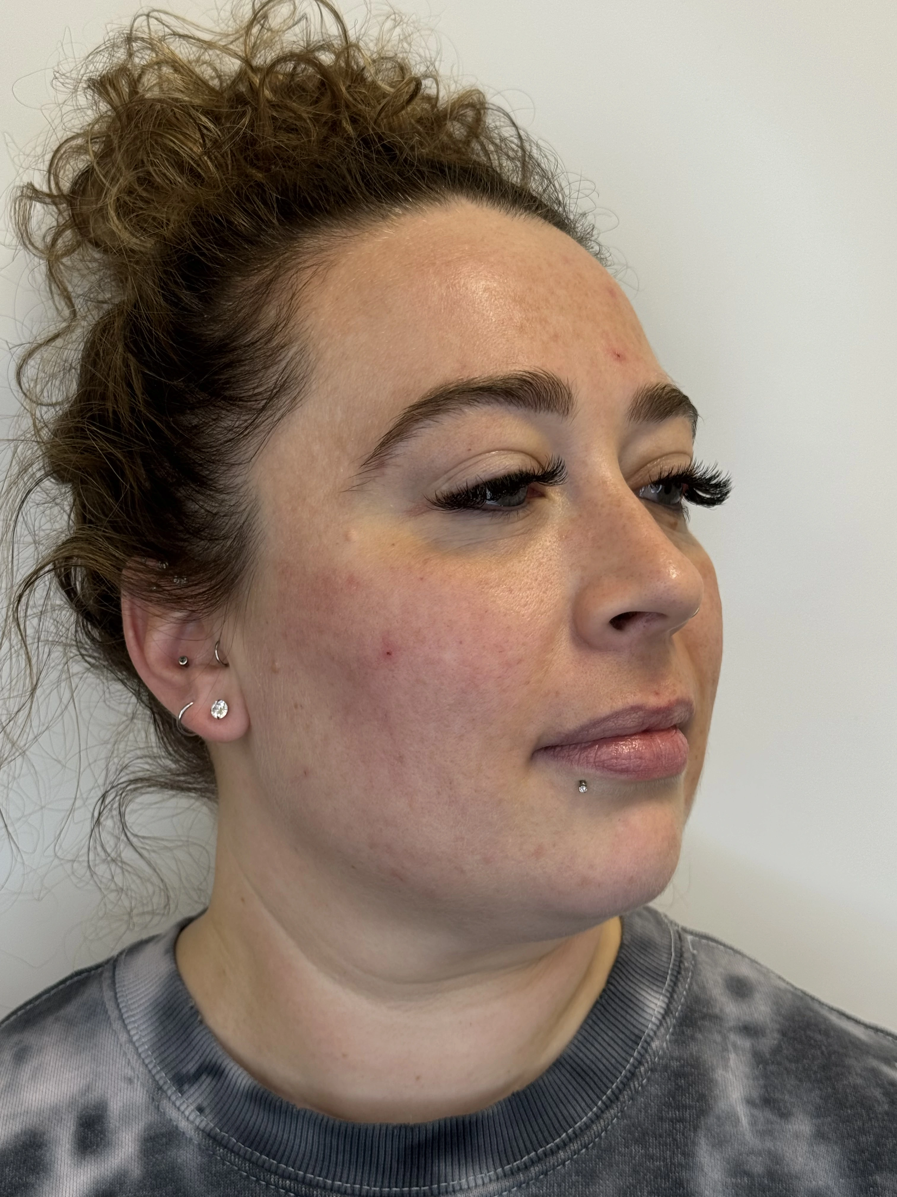 Patient after Morpheus8 BURST RF microneedling Face & Neck treatment in Kelowna, BC