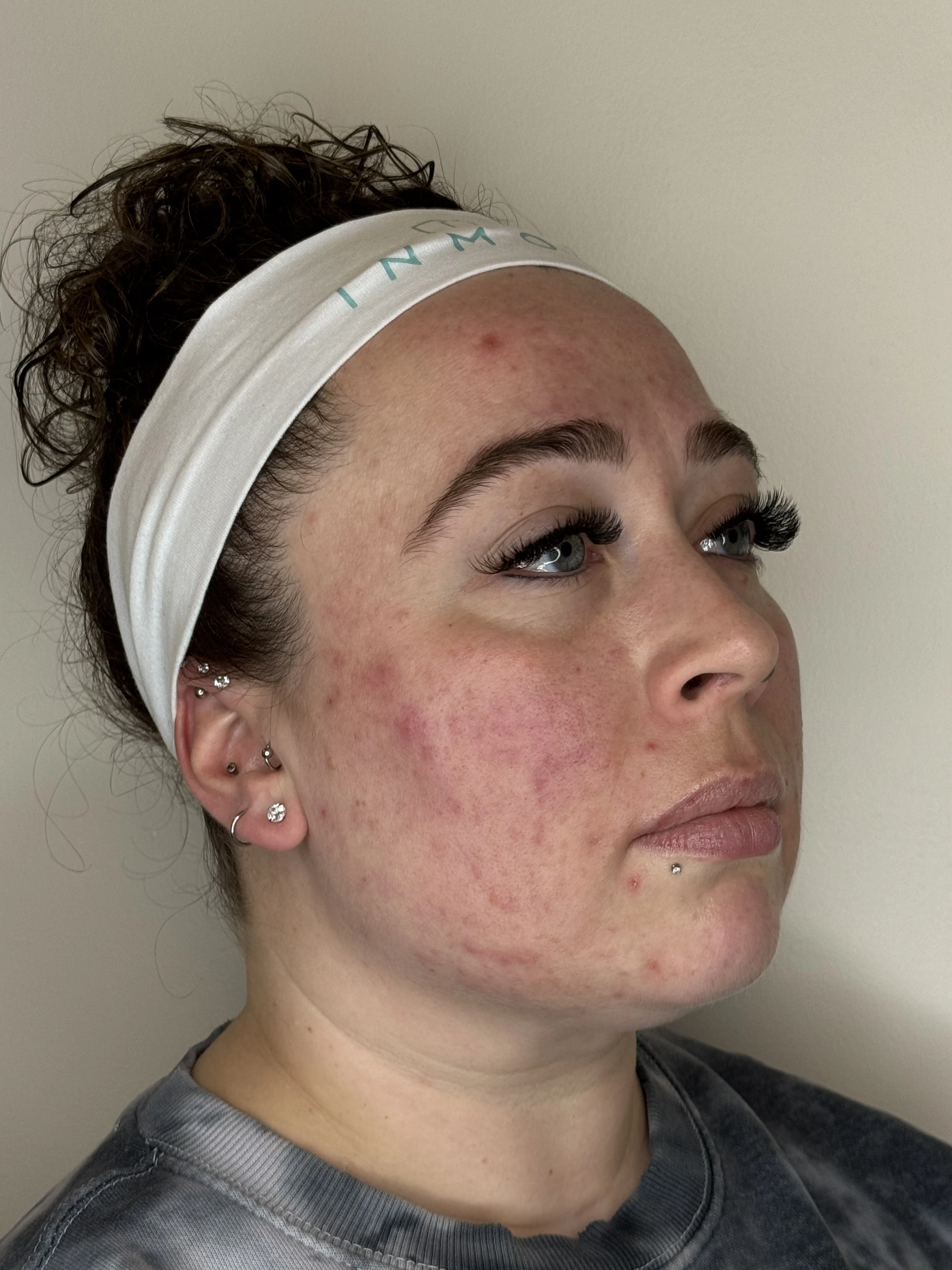 Patient before Morpheus8 BURST RF microneedling Face & Neck treatment in Kelowna, BC