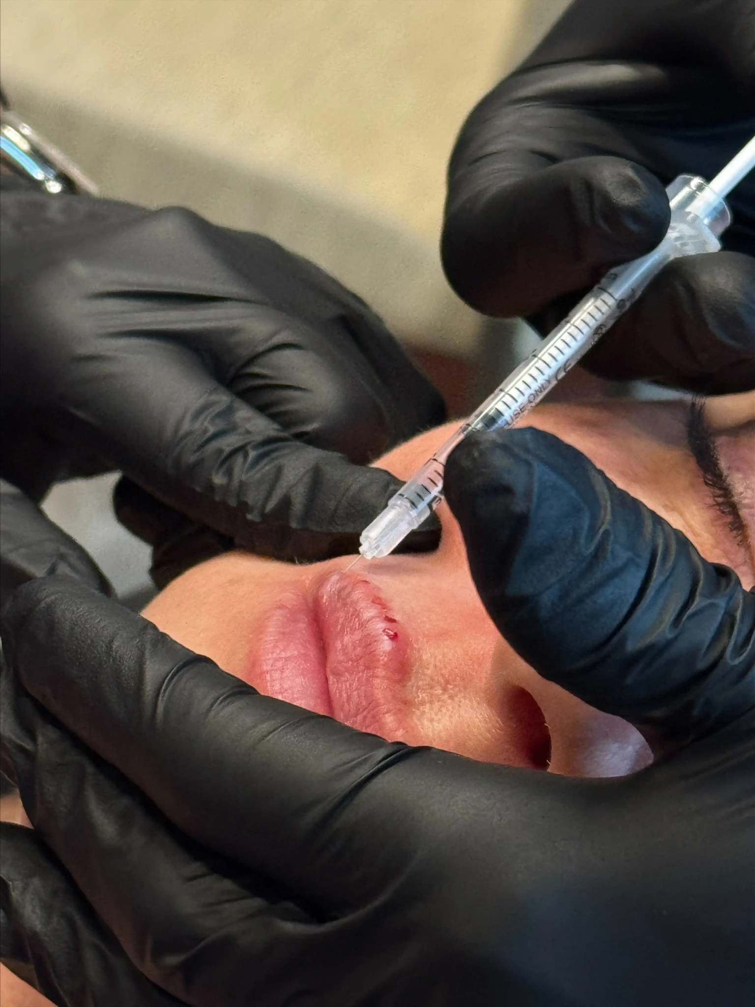 Dermal filler treatment to restore volume and contour in Kelowna, BC